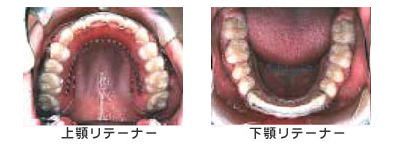 保定装置（リテーナー）